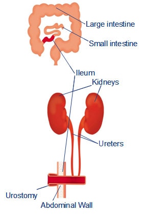 Urostómia