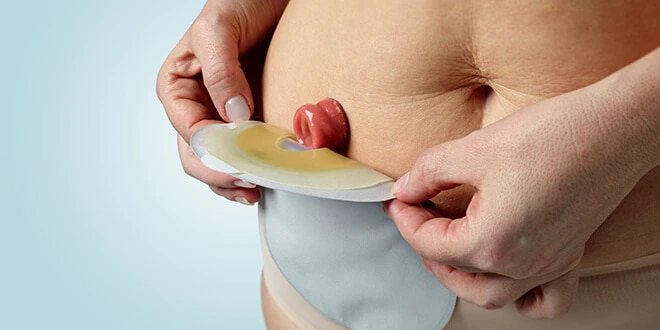 Ostomy pouch