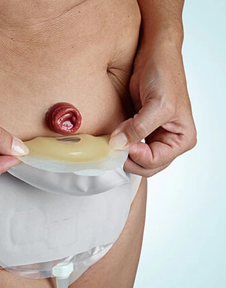 Je výmena alebo vypúšťanie urostomického vrecka náročná?