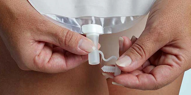 Changing your urostomy pouch
