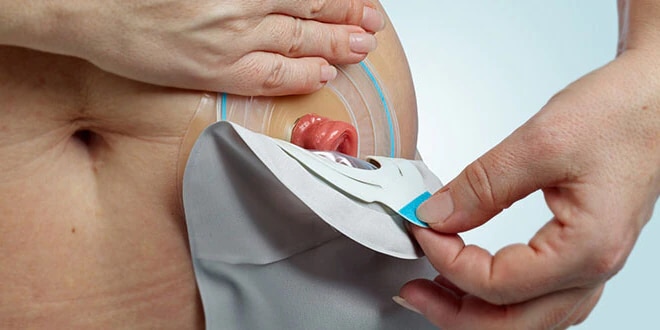 Changing your ileostomy pouch
