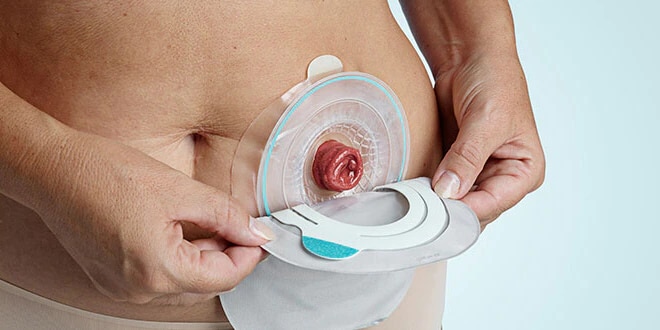 Changing your colostomy pouch
