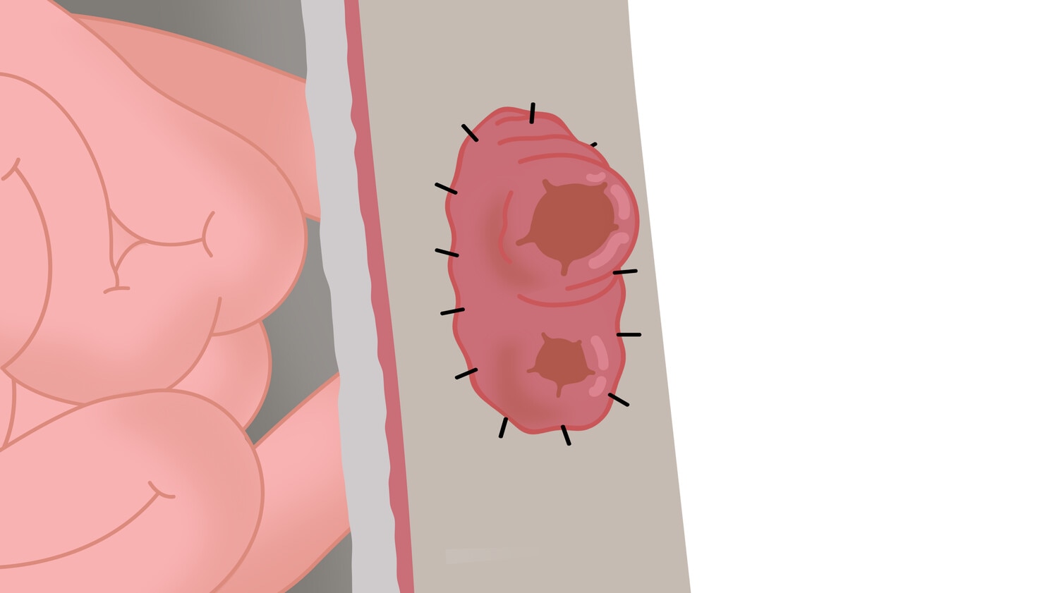 Dvojhlavňová ileostómia - detail