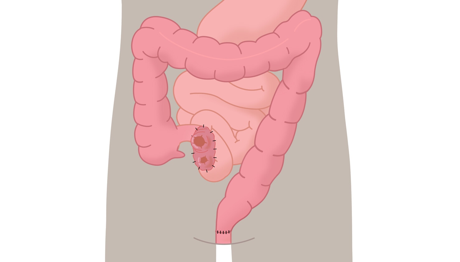 Dvojhlavňová ileostómia