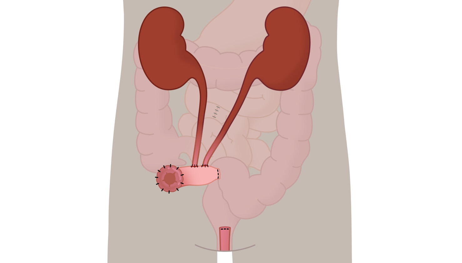 Urostómia - ureteroileostómia